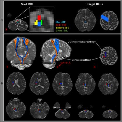 Corticoreticular Tract in the Human Brain: A Mini Review